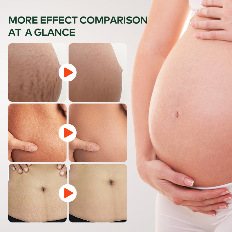 Wholesale Organic Postpartum Belly Texture Repair Skin Lubrication and Moisturizing Scar Healing Essential Oil(pic4)